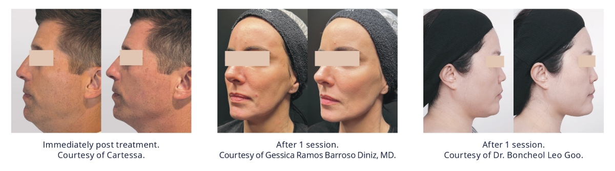 Skin Tightening and Lifting  Kennett Square, PA 
